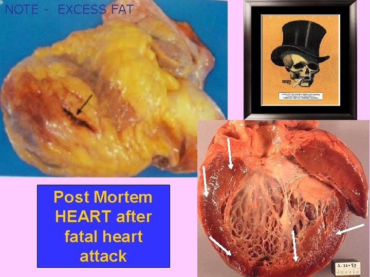 NOTE - EXCESS FAT Post Mortem HEART after fatal heart attack 