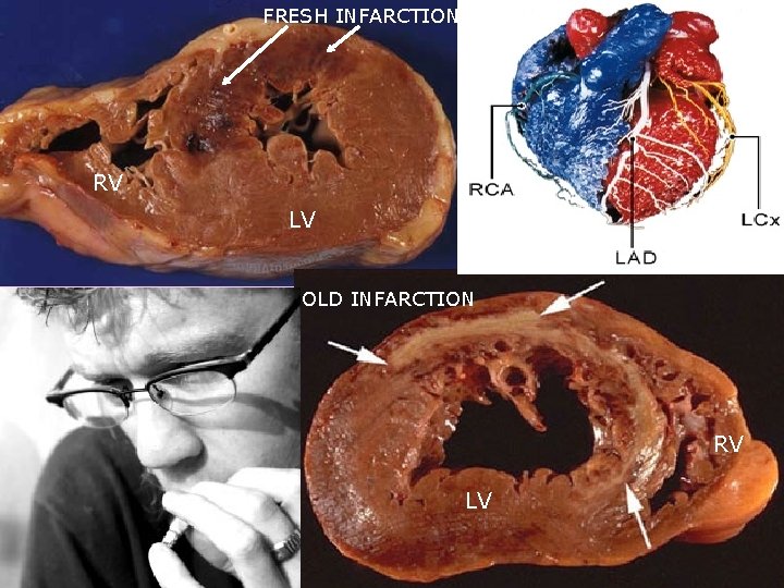 FRESH INFARCTION RV LV OLD INFARCTION RV LV 