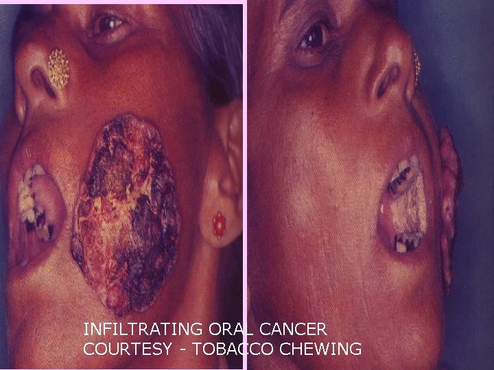 INFILTRATING ORAL CANCER COURTESY - TOBACCO CHEWING 