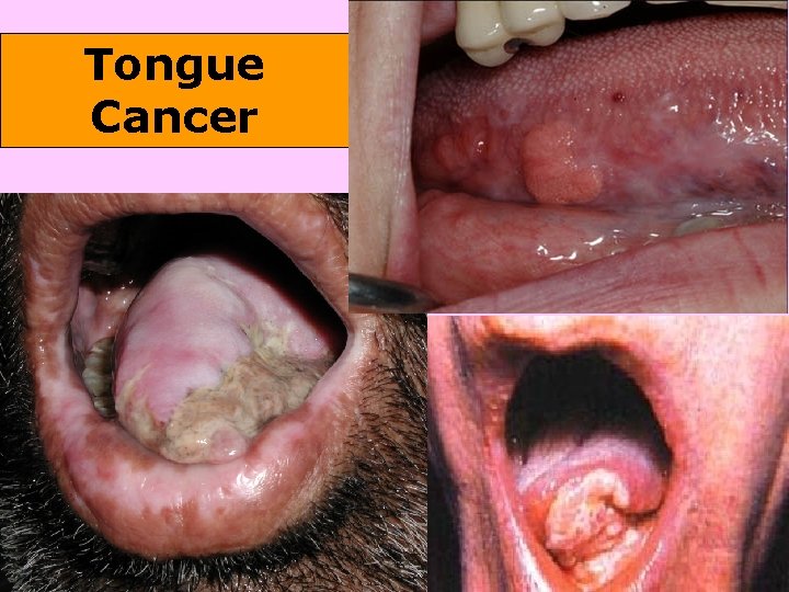 Tongue Cancer 