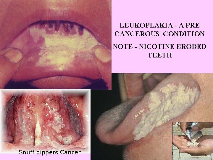 LEUKOPLAKIA - A PRE CANCEROUS CONDITION NOTE - NICOTINE ERODED TEETH Snuff dippers Cancer
