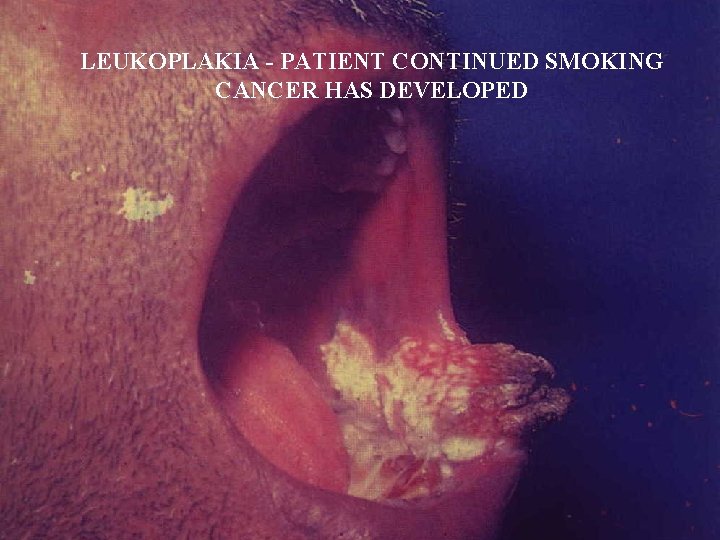 LEUKOPLAKIA - PATIENT CONTINUED SMOKING CANCER HAS DEVELOPED 