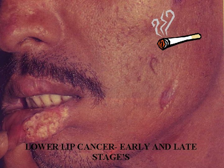 LOWER LIP CANCER- EARLY AND LATE STAGE’S 