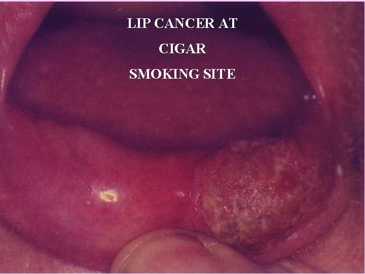 LIP CANCER AT CIGAR SMOKING SITE 