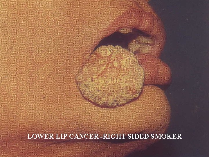 LOWER LIP CANCER -RIGHT SIDED SMOKER 