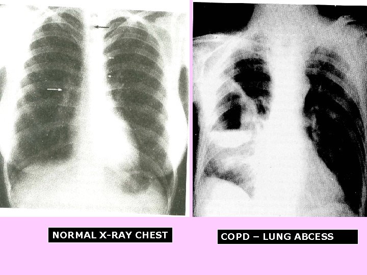 NORMAL X-RAY CHEST COPD – LUNG ABCESS 