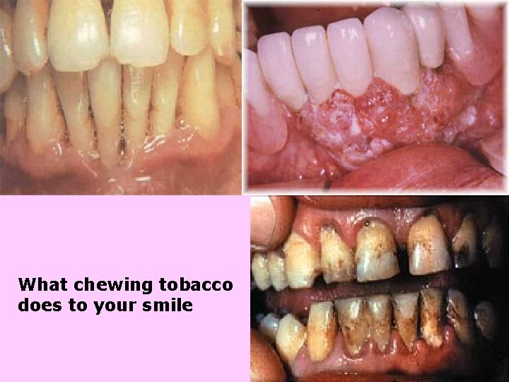 What chewing tobacco does to your smile 