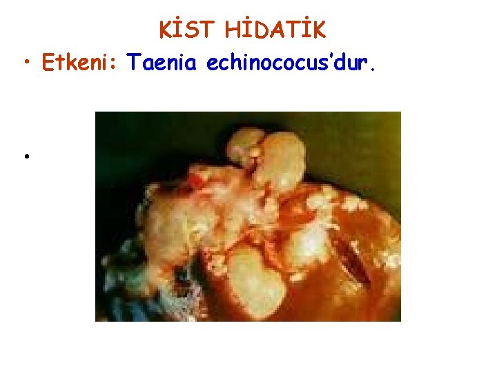 KİST HİDATİK • Etkeni: Taenia echinococus’dur. • 