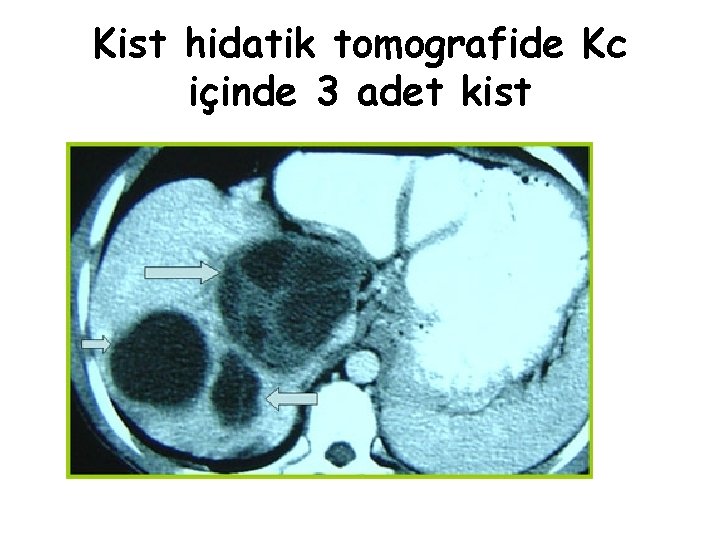 Kist hidatik tomografide Kc içinde 3 adet kist 