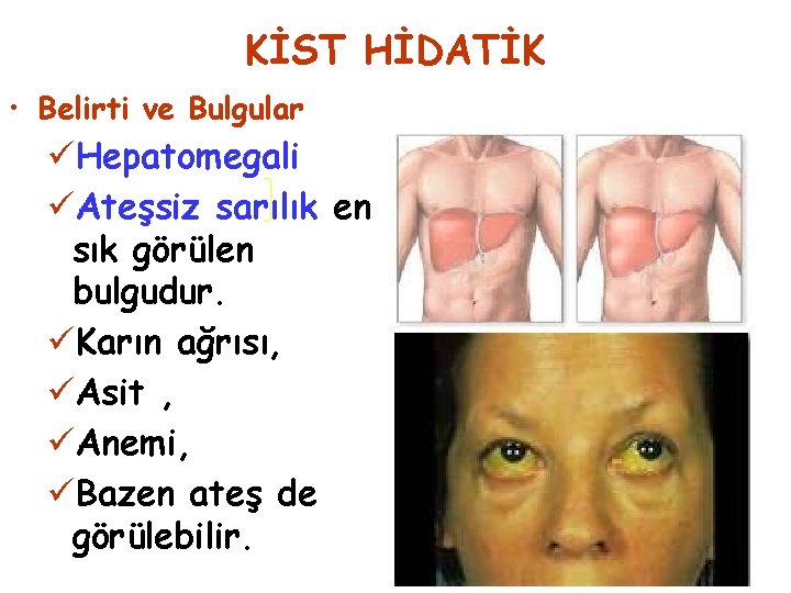 KİST HİDATİK • Belirti ve Bulgular üHepatomegali üAteşsiz sarılık en sık görülen bulgudur. üKarın