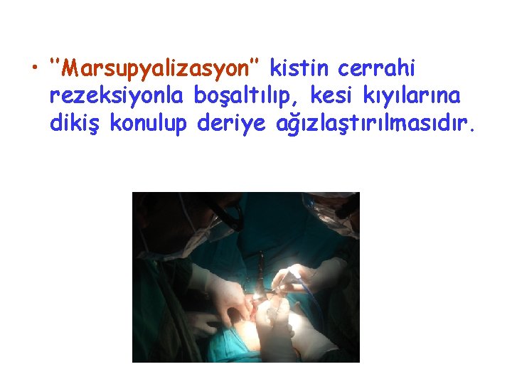  • ‘’Marsupyalizasyon’’ kistin cerrahi rezeksiyonla boşaltılıp, kesi kıyılarına dikiş konulup deriye ağızlaştırılmasıdır. 