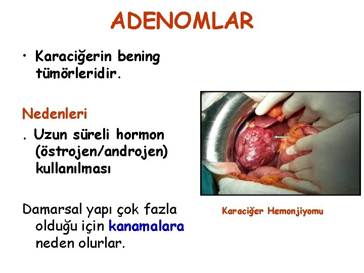 ADENOMLAR • Karaciğerin bening tümörleridir. Nedenleri. Uzun süreli hormon (östrojen/androjen) kullanılması Damarsal yapı çok