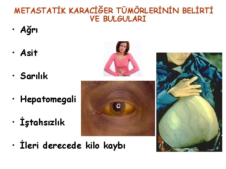 METASTATİK KARACİĞER TÜMÖRLERİNİN BELİRTİ VE BULGULARI • Ağrı • Asit • Sarılık • Hepatomegali