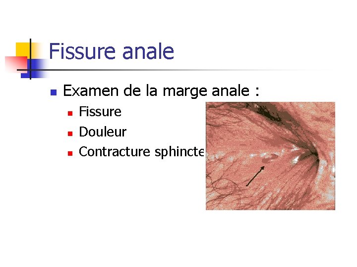 Fissure anale n Examen de la marge anale : n n n Fissure Douleur