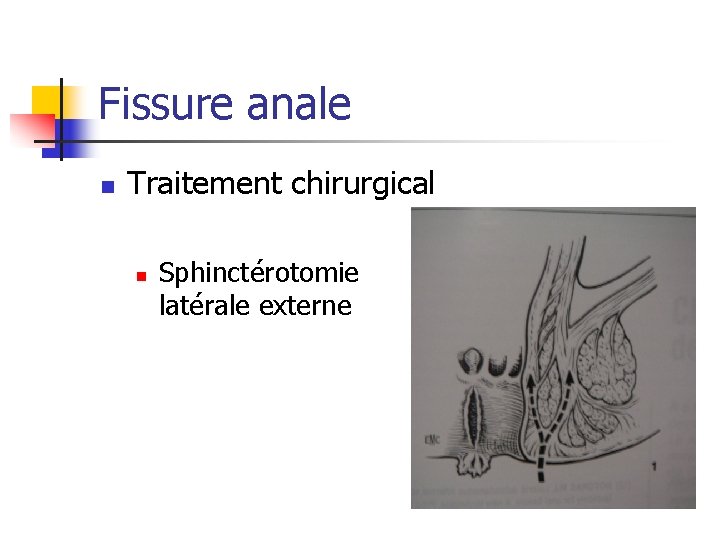 Fissure anale n Traitement chirurgical n Sphinctérotomie latérale externe 