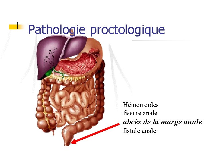 Pathologie proctologique Hémorroïdes fissure anale abcès de la marge anale fistule anale 