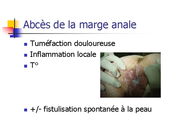 Abcès de la marge anale n Tuméfaction douloureuse Inflammation locale T° n +/- fistulisation