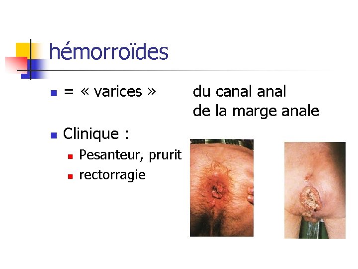 hémorroïdes n = « varices » n Clinique : n n Pesanteur, prurit rectorragie