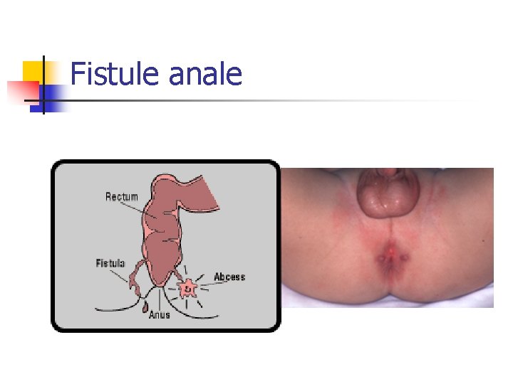 Fistule anale 