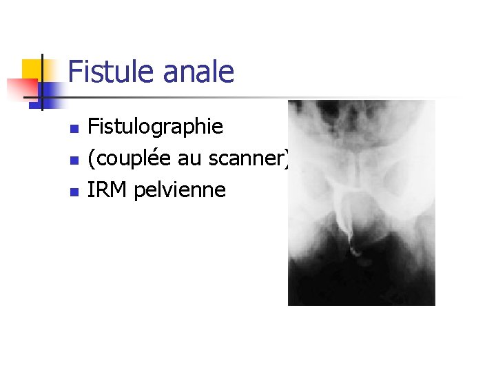 Fistule anale n n n Fistulographie (couplée au scanner) IRM pelvienne 