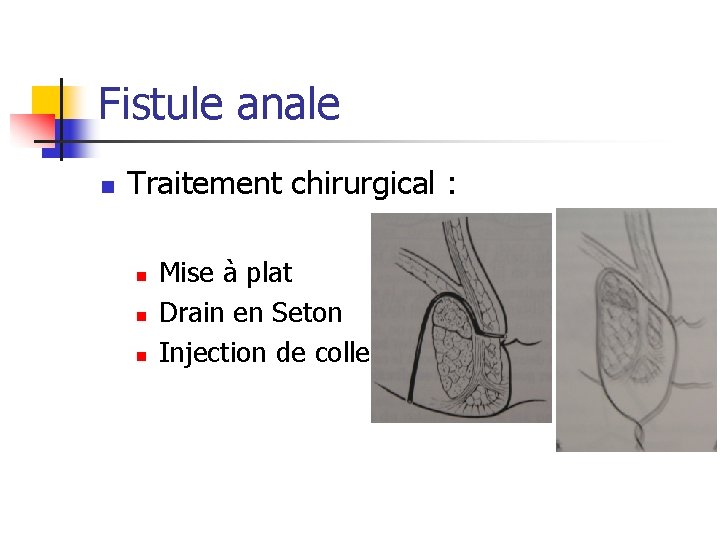 Fistule anale n Traitement chirurgical : n n n Mise à plat Drain en