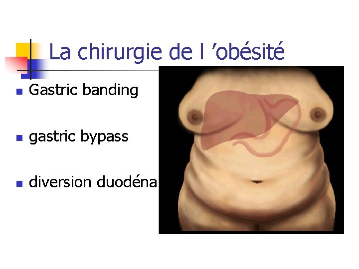 La chirurgie de l ’obésité n Gastric banding n gastric bypass n diversion duodénale