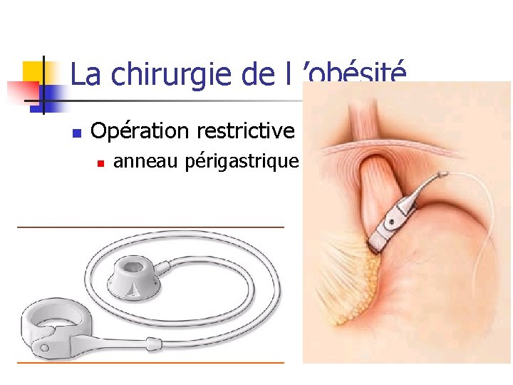 La chirurgie de l ’obésité n Opération restrictive : n anneau périgastrique : 