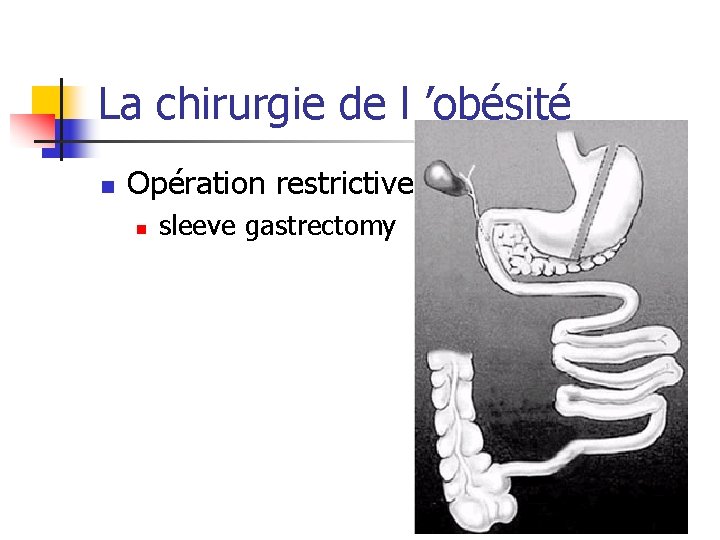 La chirurgie de l ’obésité n Opération restrictive : n sleeve gastrectomy 