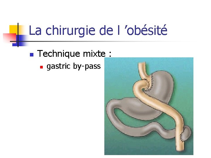 La chirurgie de l ’obésité n Technique mixte : n gastric by-pass 