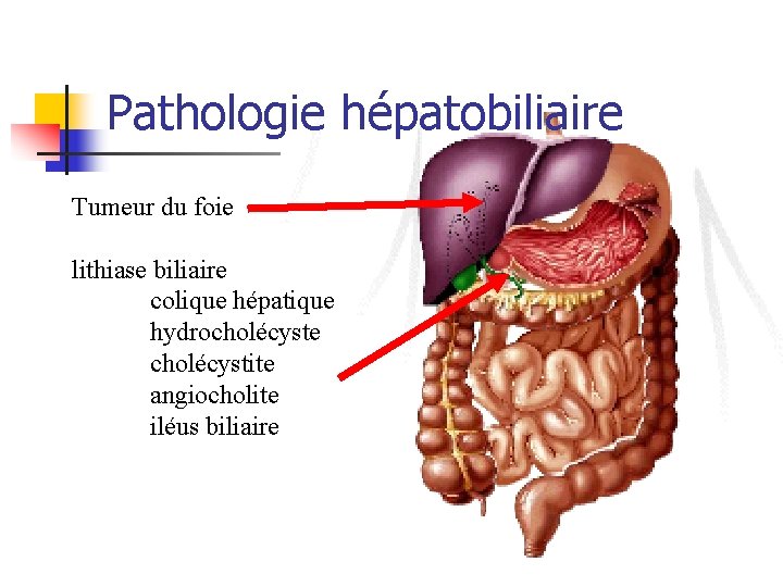 Pathologie hépatobiliaire Tumeur du foie lithiase biliaire colique hépatique hydrocholécyste cholécystite angiocholite iléus biliaire