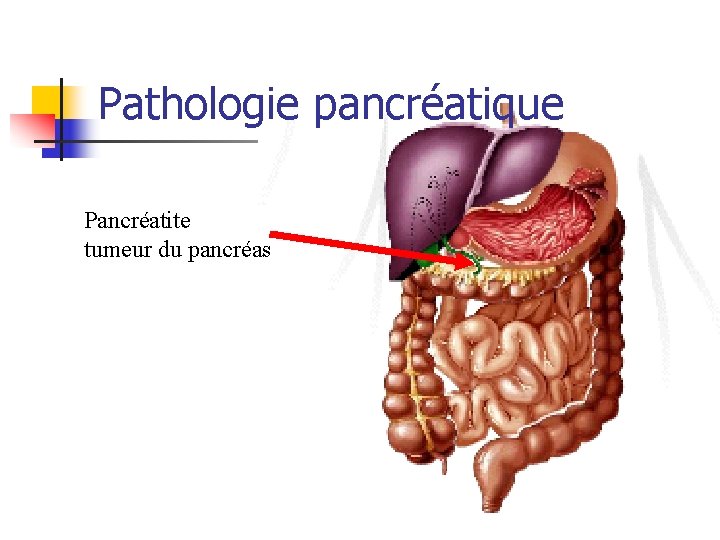 Pathologie pancréatique Pancréatite tumeur du pancréas 