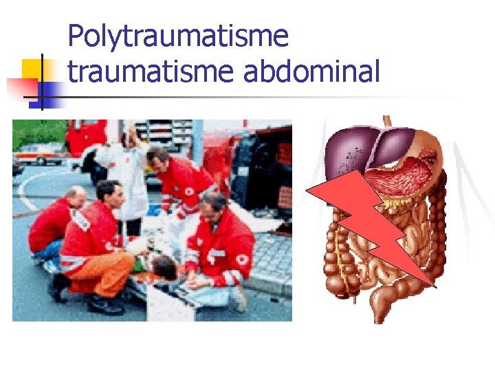 Polytraumatisme abdominal 