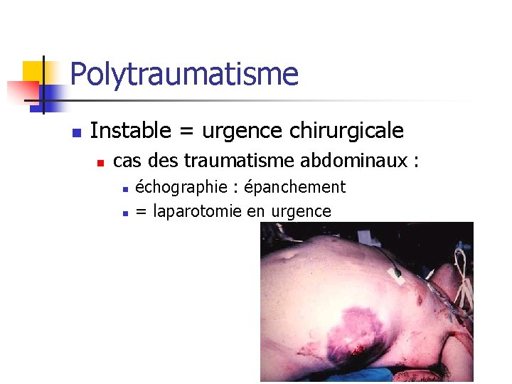 Polytraumatisme n Instable = urgence chirurgicale n cas des traumatisme abdominaux : n n