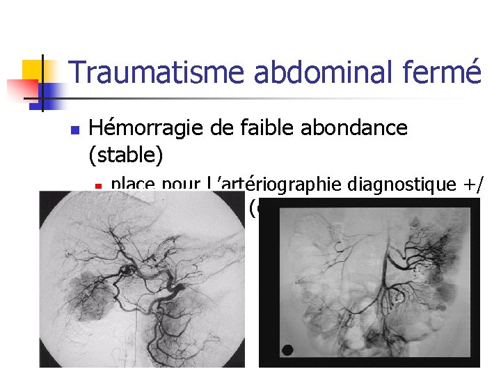 Traumatisme abdominal fermé n Hémorragie de faible abondance (stable) n place pour l ’artériographie