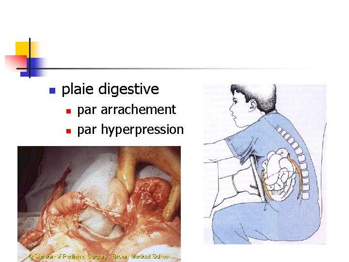 n plaie digestive n n par arrachement par hyperpression 