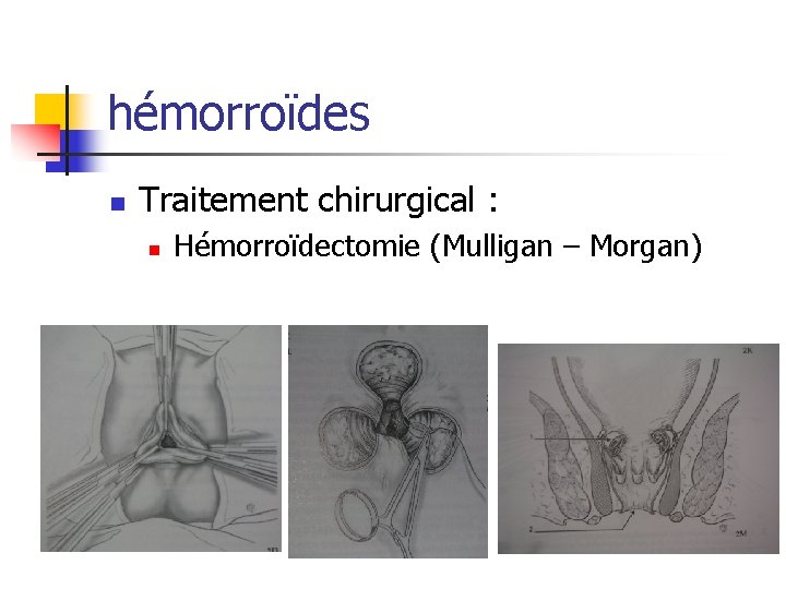 hémorroïdes n Traitement chirurgical : n Hémorroïdectomie (Mulligan – Morgan) 