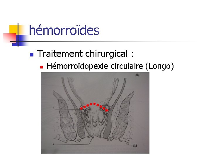 hémorroïdes n Traitement chirurgical : n Hémorroïdopexie circulaire (Longo) 