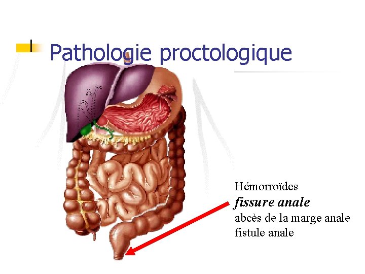 Pathologie proctologique Hémorroïdes fissure anale abcès de la marge anale fistule anale 