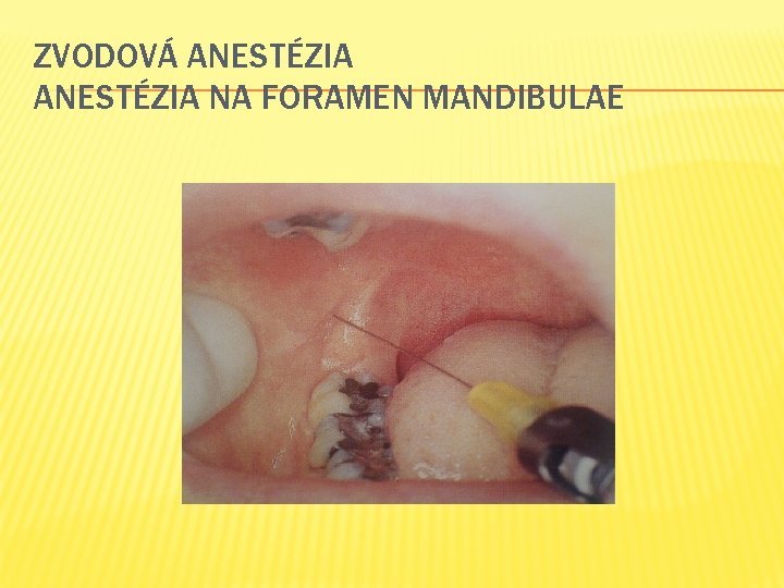 ZVODOVÁ ANESTÉZIA NA FORAMEN MANDIBULAE 