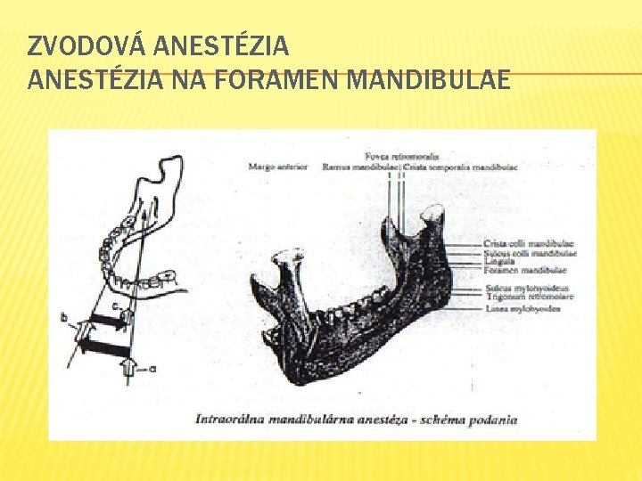 ZVODOVÁ ANESTÉZIA NA FORAMEN MANDIBULAE 