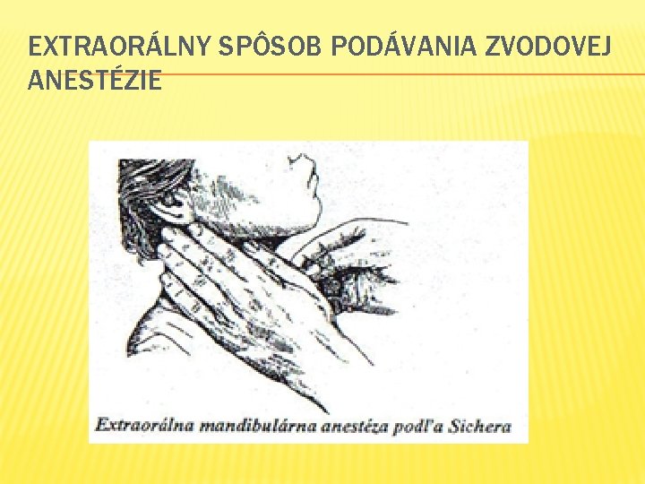 EXTRAORÁLNY SPÔSOB PODÁVANIA ZVODOVEJ ANESTÉZIE 