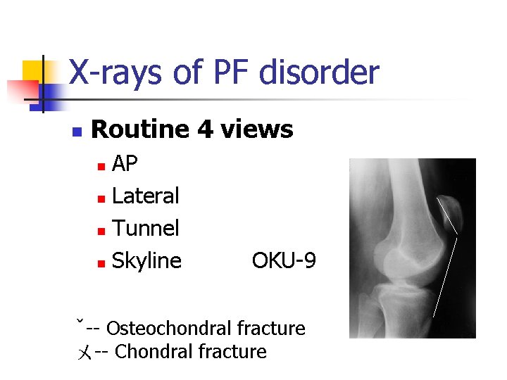 X-rays of PF disorder n Routine 4 views AP n Lateral n Tunnel n