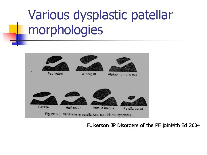 Various dysplastic patellar morphologies Fulkerson JP Disorders of the PF joint 4 th Ed
