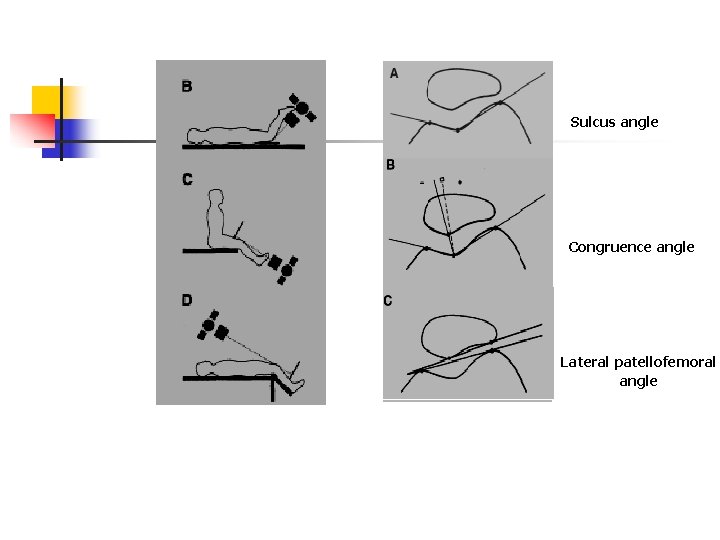 Sulcus angle Congruence angle Lateral patellofemoral angle 