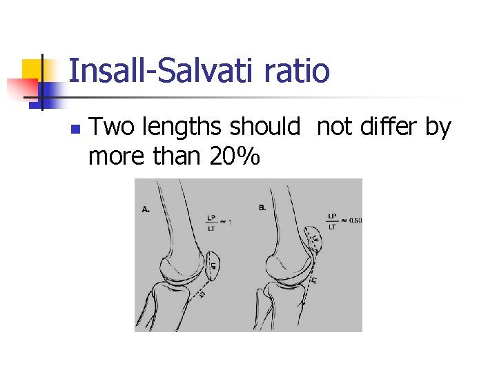 Insall-Salvati ratio n Two lengths should not differ by more than 20% 
