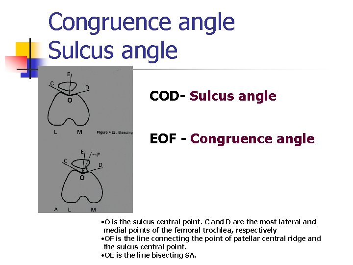 Congruence angle Sulcus angle COD- Sulcus angle o EOF - Congruence angle o •