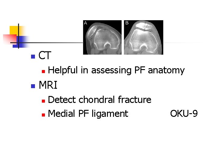 n CT n n Helpful in assessing PF anatomy MRI Detect chondral fracture n