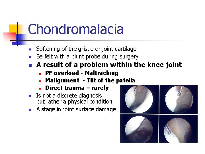 Chondromalacia n Softening of the gristle or joint cartilage Be felt with a blunt