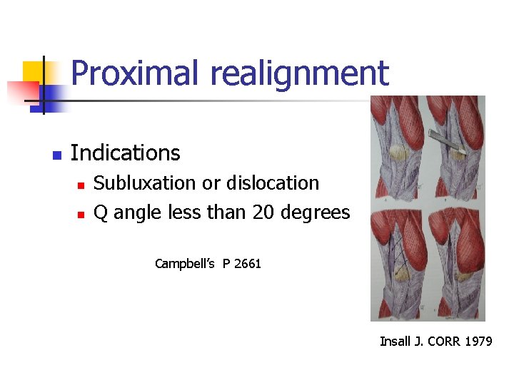 Proximal realignment n Indications n n Subluxation or dislocation Q angle less than 20