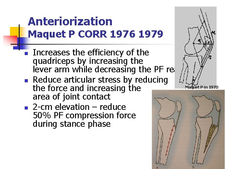 Anteriorization Maquet P CORR 1976 1979 n n n Increases the efficiency of the